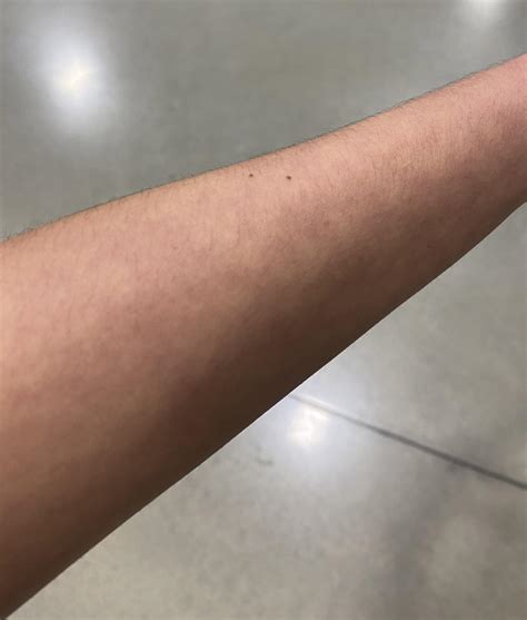 Can anyone tell me what’s this called? Happens to my skin in the cold