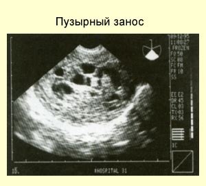 Диагностика | Пузырный занос: самая полная информация