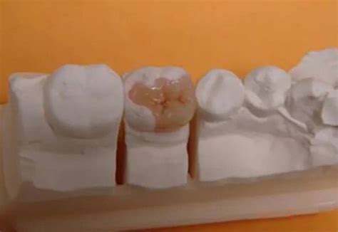 Porcelain Onlay Case - Central burlington Dental Care