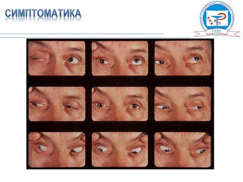 Миастенический криз - презентация онлайн