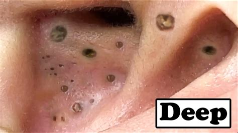 Forget Everything You Know: Unbelievable Blackhead Removal 2024 Revealed - 499zazm