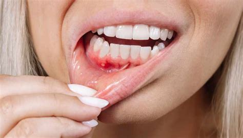 Стоматит 6 Лучших Домашних Способов Лечения