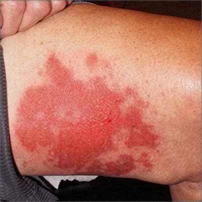 Leg rash | Clinician Reviews