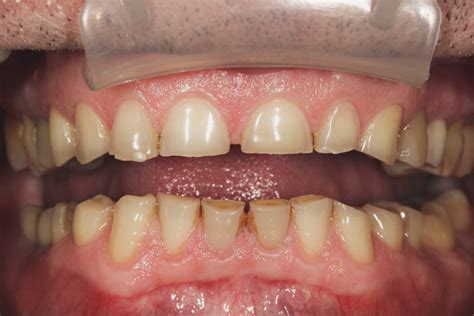 bruxism  teeth grinding private dentist  sheffield