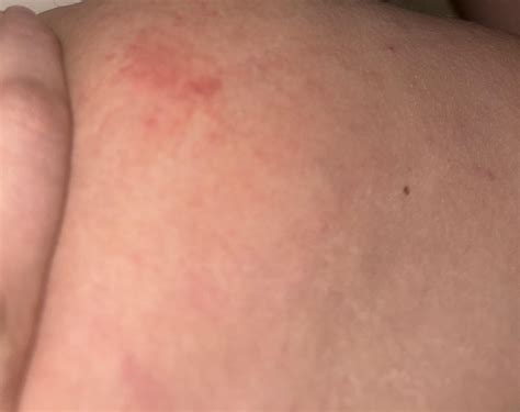 Rash on inner thigh? Multiplying..? : r/DermatologyQuestions