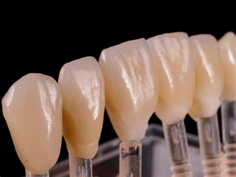 Veneers – Bade Zahntechnik Dentallabor