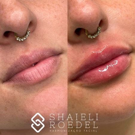 Preenchimento Grandes Lábios Antes E Depois - Preenchimento labial antes e depois, veja transformações.