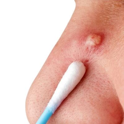 BOILS - Dermatology Associates