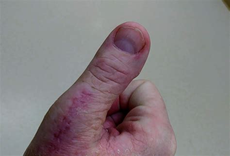 buzzletter update robs dislocated thumb surgery