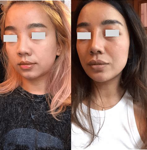 Can I dissolve lip filler on my own? : r/PlasticSurgery