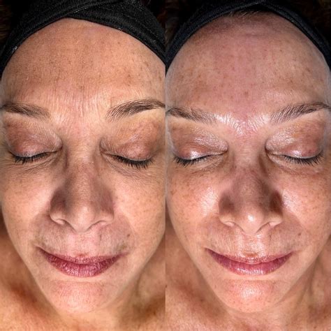 HydraFacial Treatment Before And After | Tampa, FL