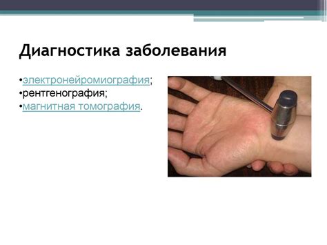 Нейропатии рук (локтевой, лучевой, срединый.) - презентация онлайн