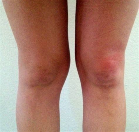 What Causes Below The Knee Swelling
