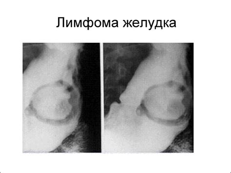 Лимфопролиферативные заболевания - презентация онлайн