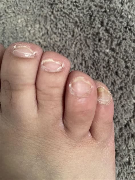 My oral terbinafine progress for toenail fungus. Day 1 was 6/16/22 ...