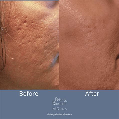 Will Sun Help Acne Scars at Keira Jeanneret blog