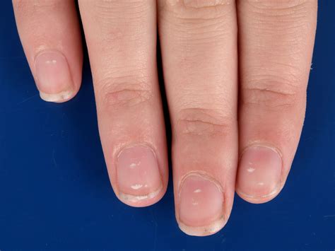 Leukonychia Striata – Leuconychie : Symptômes, causes, traitement – EDNEU