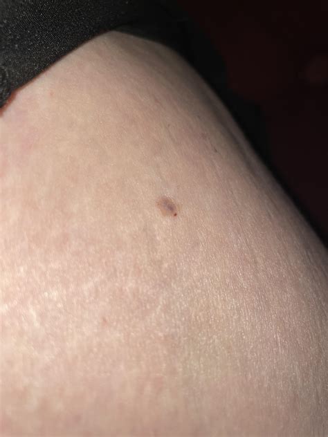 Not sure what this is on my outer left thigh. It does not itch, does