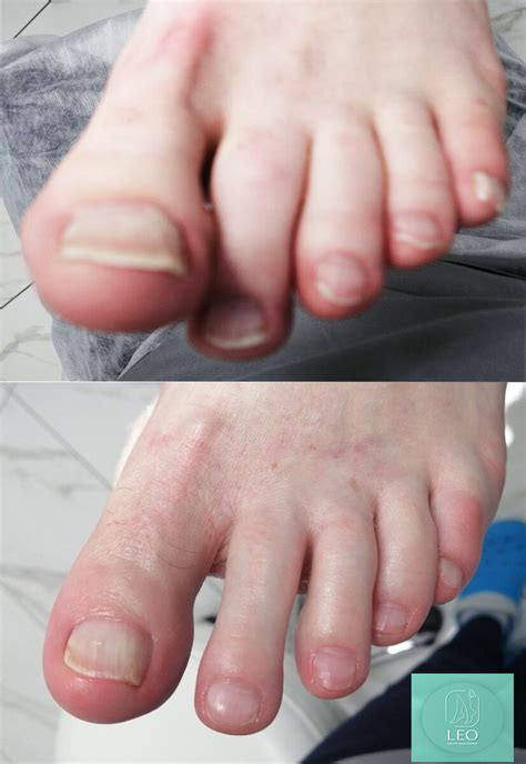 Особенности ухода за диабетической стопой | Leo Beauty | Центр ...