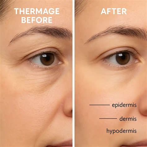 thermage  ultimate guide   surgical skin tightening  women