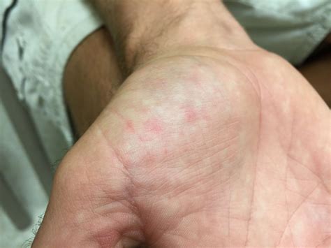 35 Facts About Janeway Lesion - Facts.net