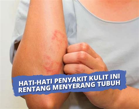 penyakit kulit   menyerang  mengobatinnya