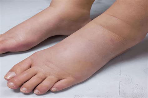 Leg swelling | Supreme Vascular and Interventional Clinic
