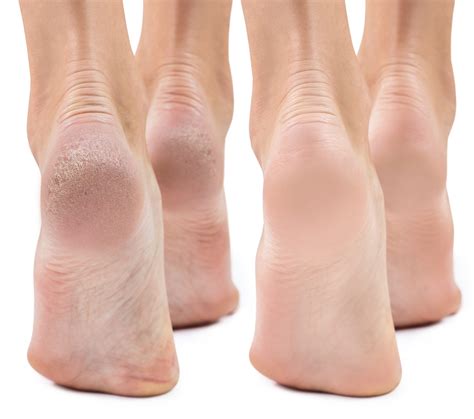 Can Dry Skin Cause Foot Pain at Robert Keck blog