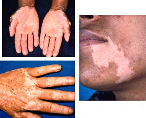 maladie daddison symptomes diagnostic  traitement