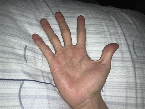 im hyperhidrosis as you can see, please let me know if you know