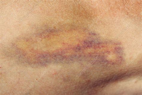 bruise stock image  science photo library
