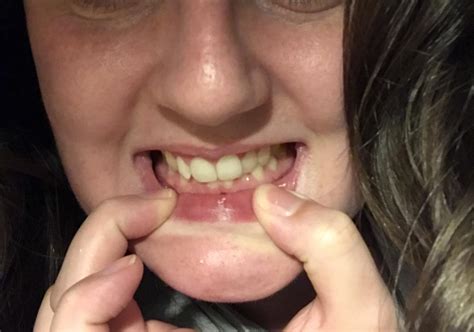 advice  invisalign straighten  slanted jaw rinvisalign