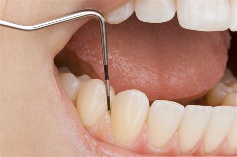 The Periodontal Assessment - Revise Dental