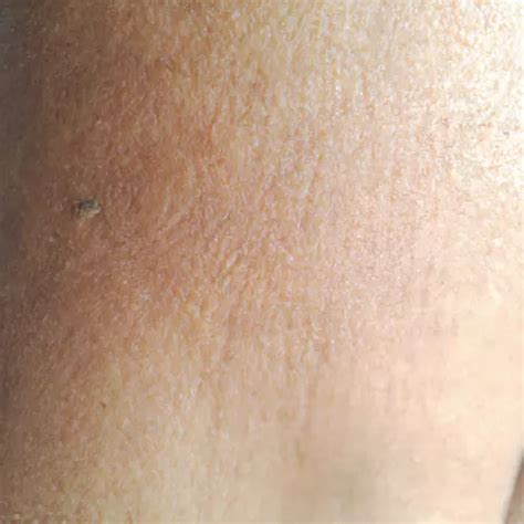 Light Brown Spots on the Legs - Health Advisor