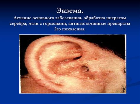 Заболевания наружного среднего и внутреннего уха в детском возрасте ...