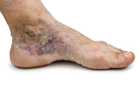Varicose veins can be cause of foot pain – Dr. Nicholas Campitelli