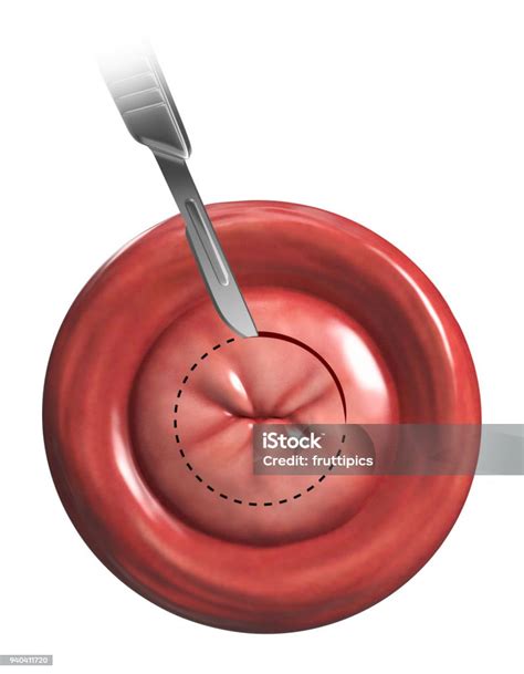 Cone Biopsy Illustration Stock Photo - Download Image Now - Anatomy ...