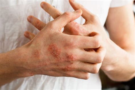 treatments   people  moderate  severe eczema  neat
