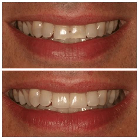 Ceramic Veneers NYC - Dental Veneers Midtown Manhattan