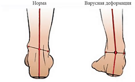 Варусная деформация стопы у детей: симптомы, лечение, фото | Все о ...