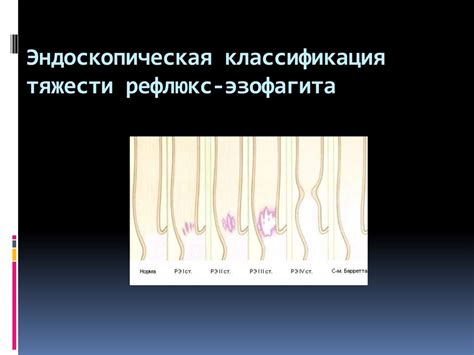 Рефлюкс-эзофагит - презентация онлайн