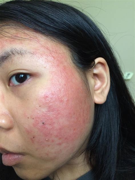 Allergic Reaction On Face From Foundation at Terrance Mitchell blog
