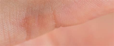 Wart (Verruga) (HPV). - Ciocca Dermatology