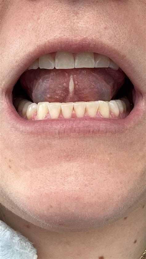 White/painful lingual frenulum : r/askdentists