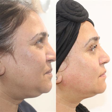HIFU for Double Chin & Jawline: Real Results, Zero Downtime