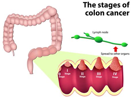 Conditions - Colorectal cancer - Dr. Markides