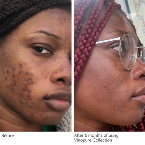 Caudalie Vinopure Natural Salicylic Acid Pore Minimizing Serum