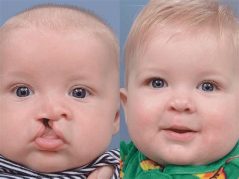 Cleft Lips After Surgery | Lipstutorial.org