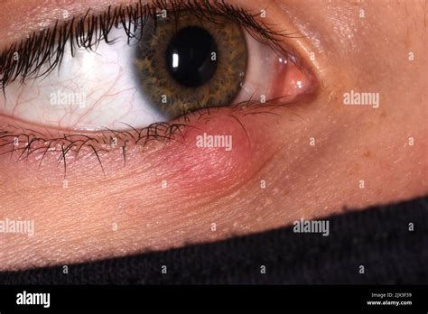 close  showing granulation tissue    eyelid    year