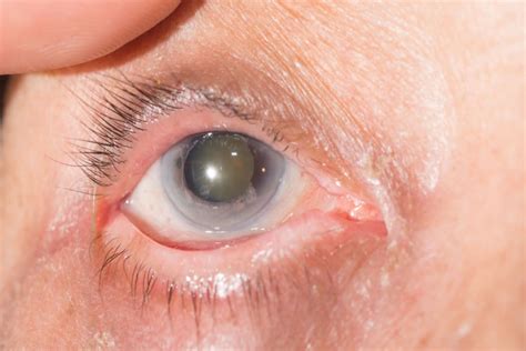 Nuclear Sclerosis: Signs, Progression & Treatment | MyVision.org